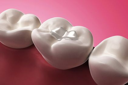 dental-fillings-image